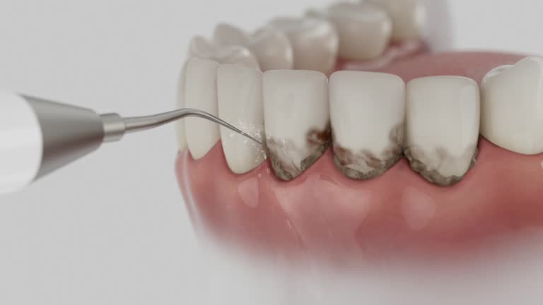 Trusted Wisdom Tooth Removal service in Mount Carmel, IL - Dentist Open Now